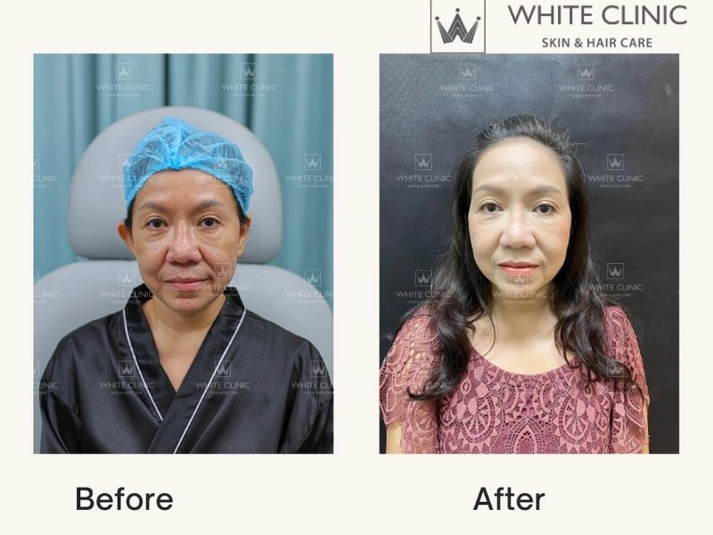 Giải pháp điều trị thâm khoa học và bền vững tại White Clinic