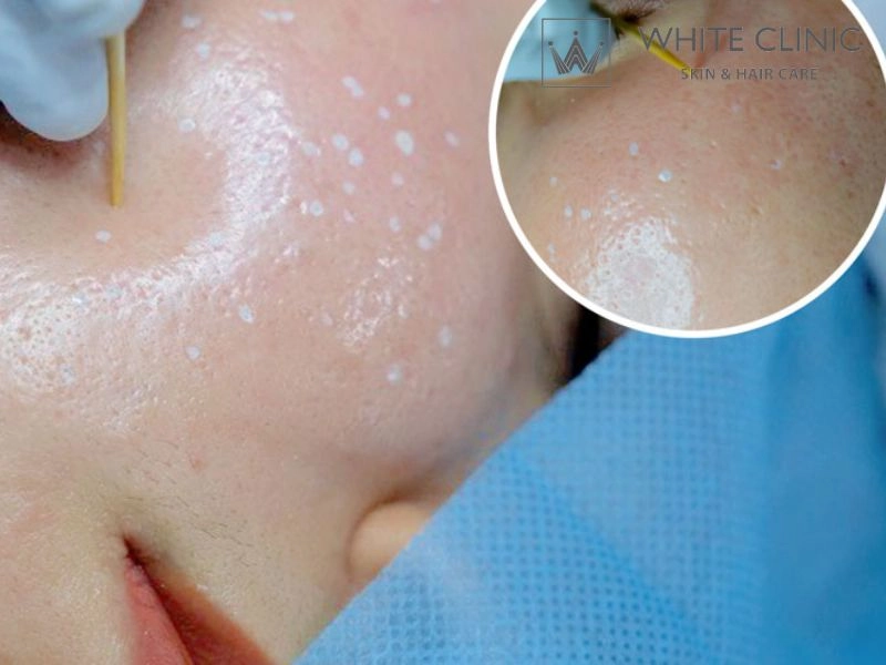 Chấm TCA Chấm TCA