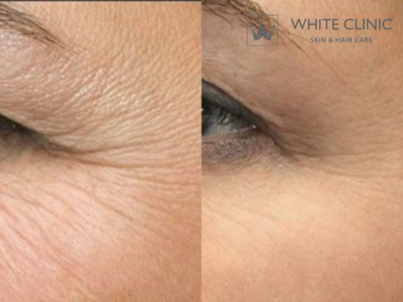 tiêm botox xoá nhăn mắt tiêm botox xoá nhăn mắt