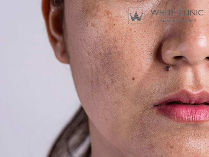 Tăng Sắc Tố Sau Viêm Da Có Hết Không? Thời Gian Hồi Phục Và Lộ Trình Cải Thiện An Toàn