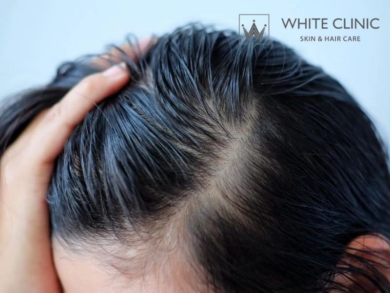 Kiểm soát da đầu nhờn tóc bết: Nhận diện nguyên nhân để xử lý đúng cách