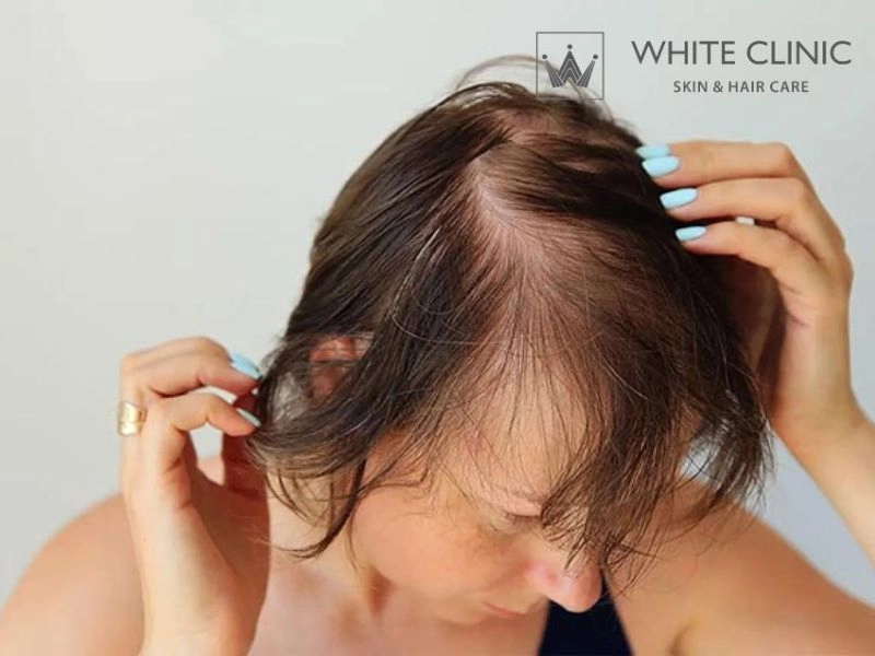 rụng tóc khi mang thai