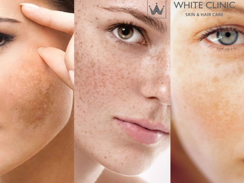 bắn laser trị nám bắn laser trị nám