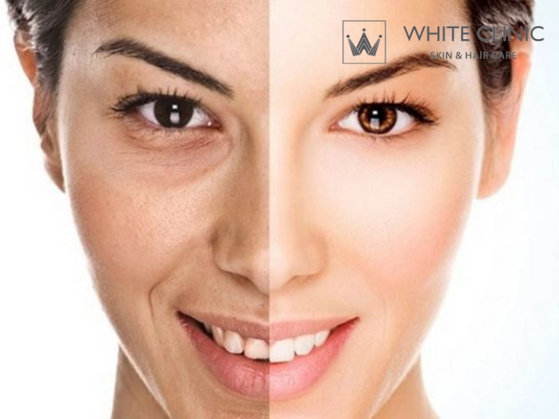 tiêm botox có bị đơ không