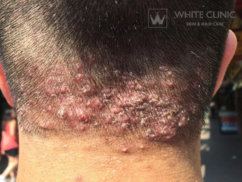 viêm nang lông da đầu