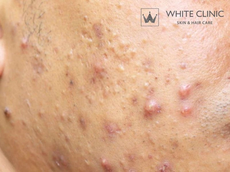 Hệ lụy nghiêm trọng từ việc tự ý điều trị mụn viêm tại nhà sai phương pháp