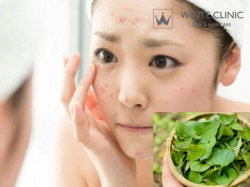 rau diếp cá trị mụn