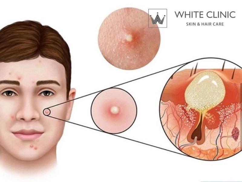 mụn bọc