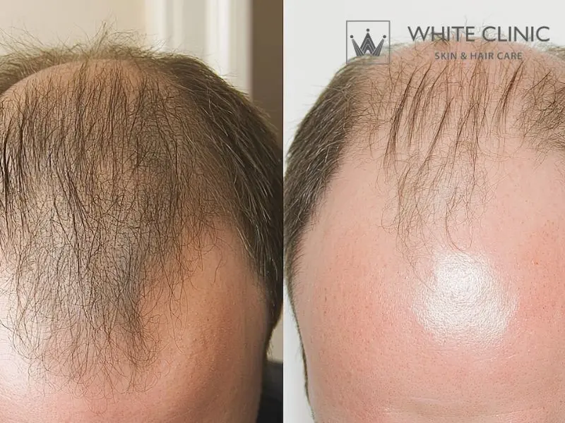 Hói Đầu Nam Nguyên Nhân Là Do Đâu? Và Phương Pháp Điều Trị Hiệu Quả