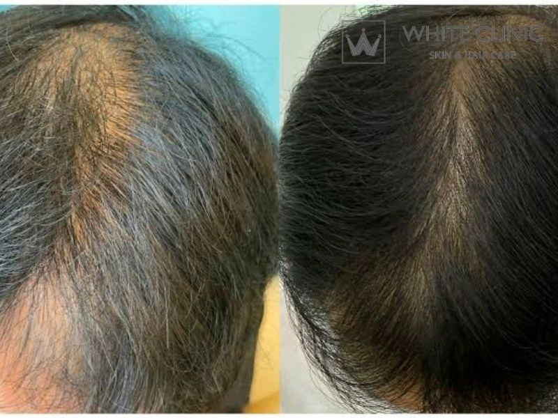 minoxidil gây rụng tóc minoxidil gây rụng tóc